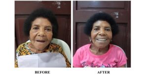 capitol-distributes-dentures-to-indigents